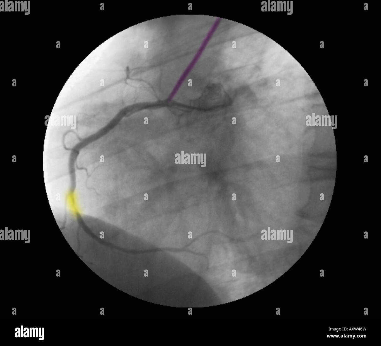 In modo digitale avanzata, colorizzato raggi x di un angiogramma coronarico che mostra la stenosi dell'arteria coronaria destra Foto Stock