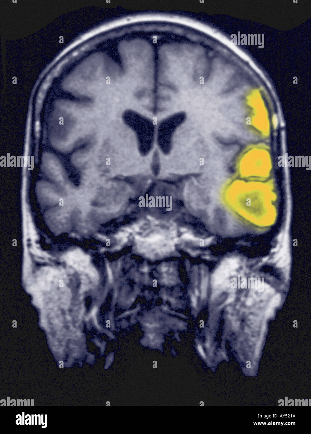 Temporoparietal emorragia cerebrale corsa in 77 anni femmina mostrato su una scansione in MRI Foto Stock