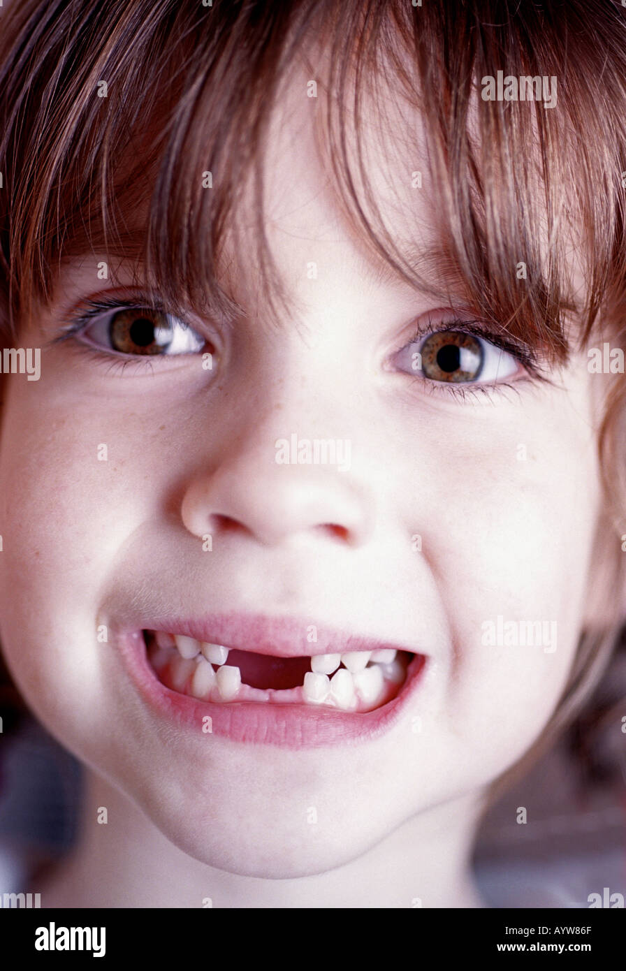 Una giovane ragazza che mostra la sua anteriore mancanti due denti superiori e inferiori Foto Stock