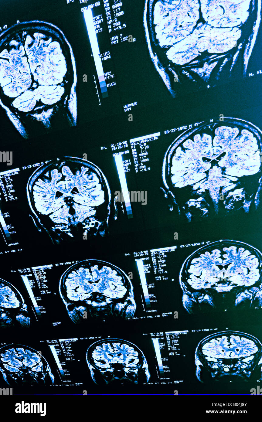 I raggi x della corteccia cerebrale umana di cervelletto di risonanza magnetica cerebrale Foto Stock
