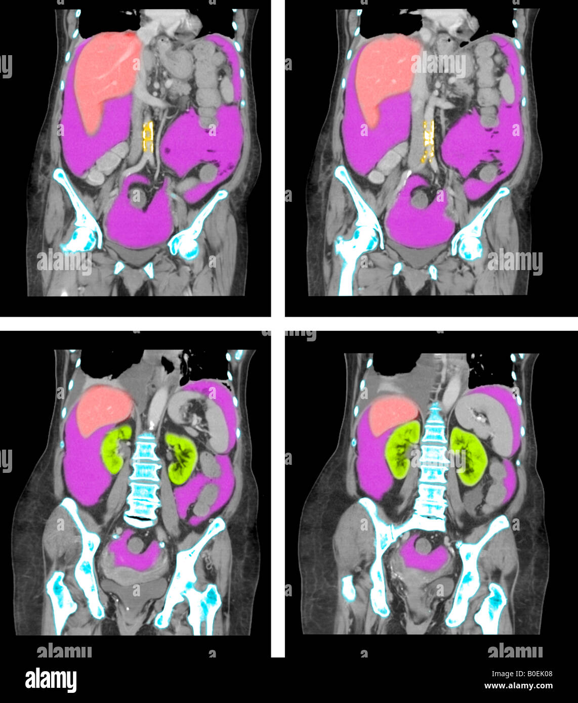 CT dell'addome e pelvi di 77 anni femmina con il cancro Foto Stock