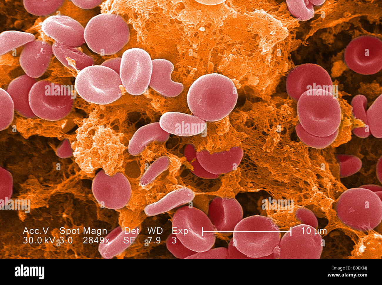 Scansione colorizzato immagine al microscopio elettronico di un coagulo di sangue Foto Stock