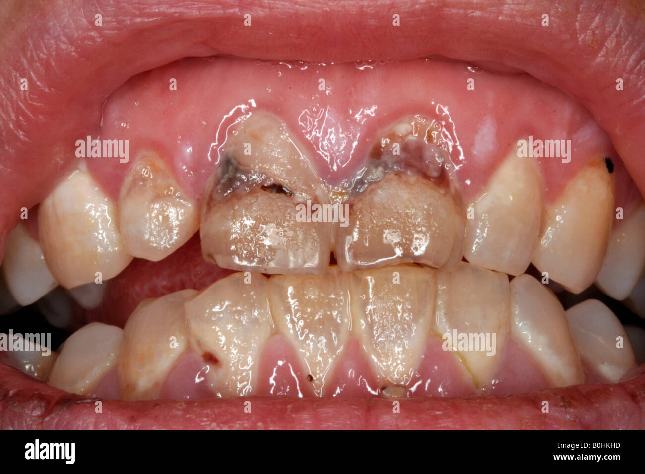 La carie dentale, inquadratura ravvicinata di una bocca con denti difettoso Foto Stock