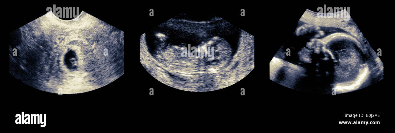 Immagine ecografica del feto di scansione Foto Stock
