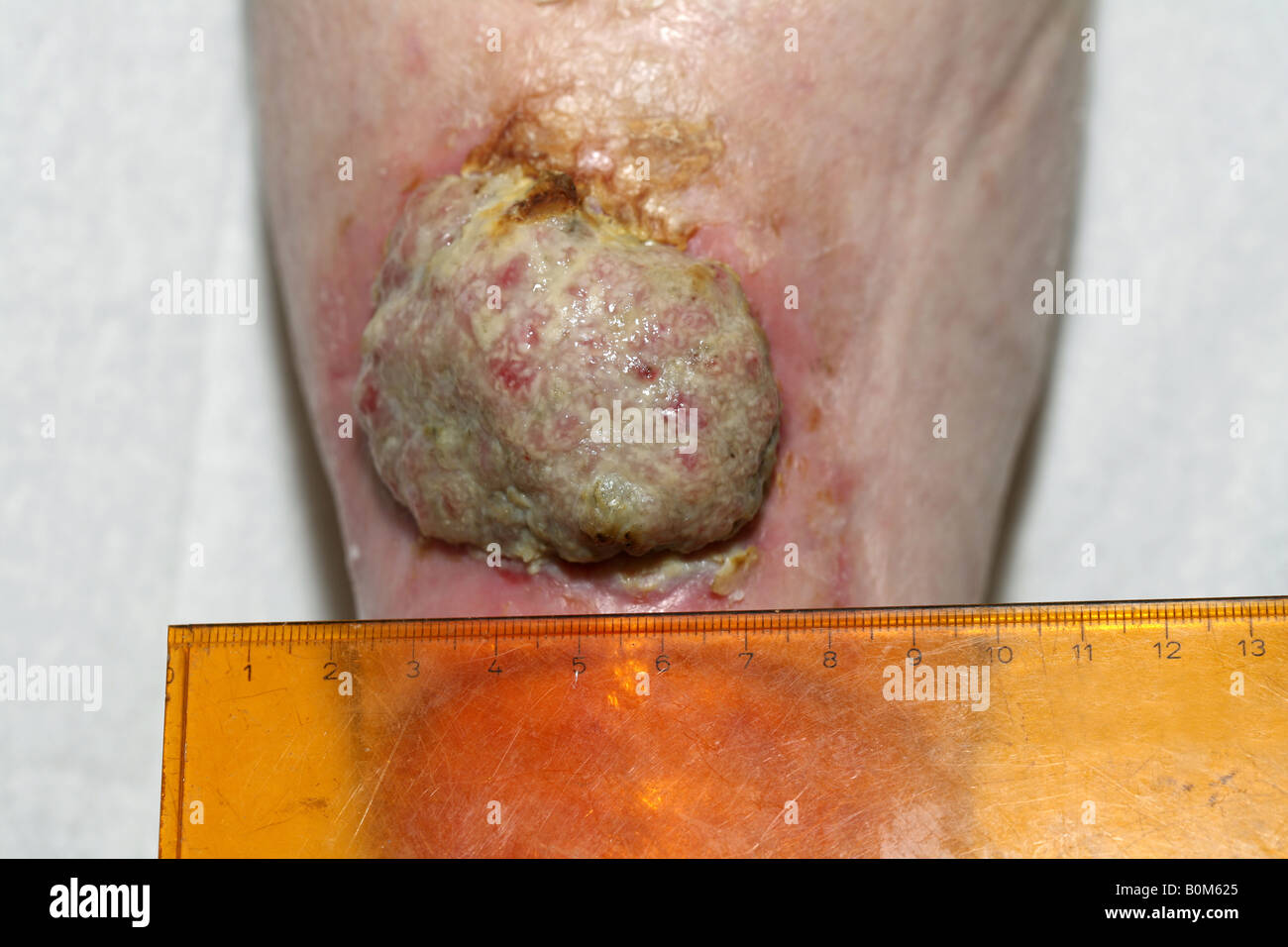 Un 5cm maligni il carcinoma a cellule squamose (cancro della pelle) sulla parte inferiore della gamba di una donna anziana Foto Stock