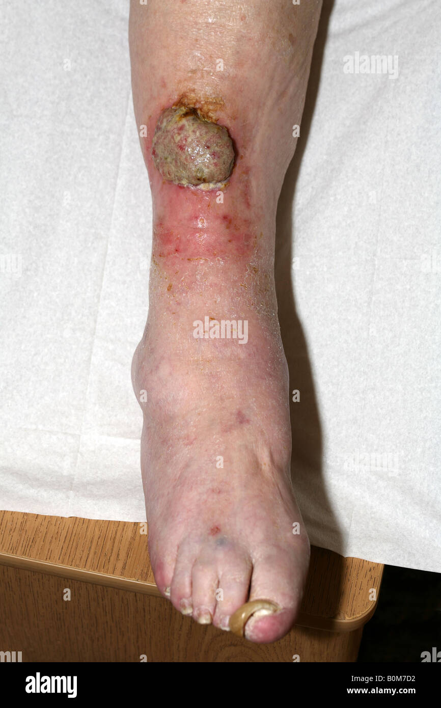 Un 5cm maligni il carcinoma a cellule squamose (cancro della pelle) sulla parte inferiore della gamba di una donna anziana Foto Stock