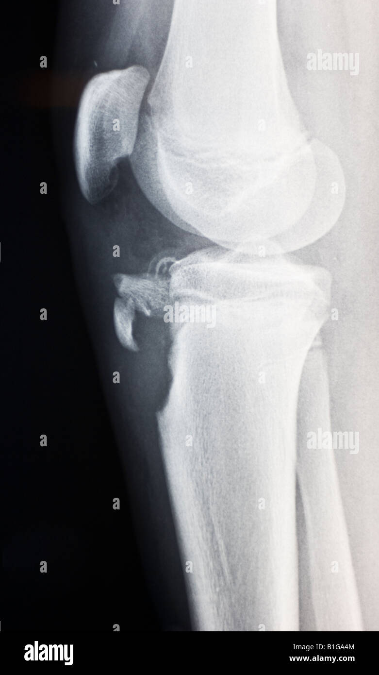 X-ray ginocchio osgood schlatter avulsione frattura Foto Stock