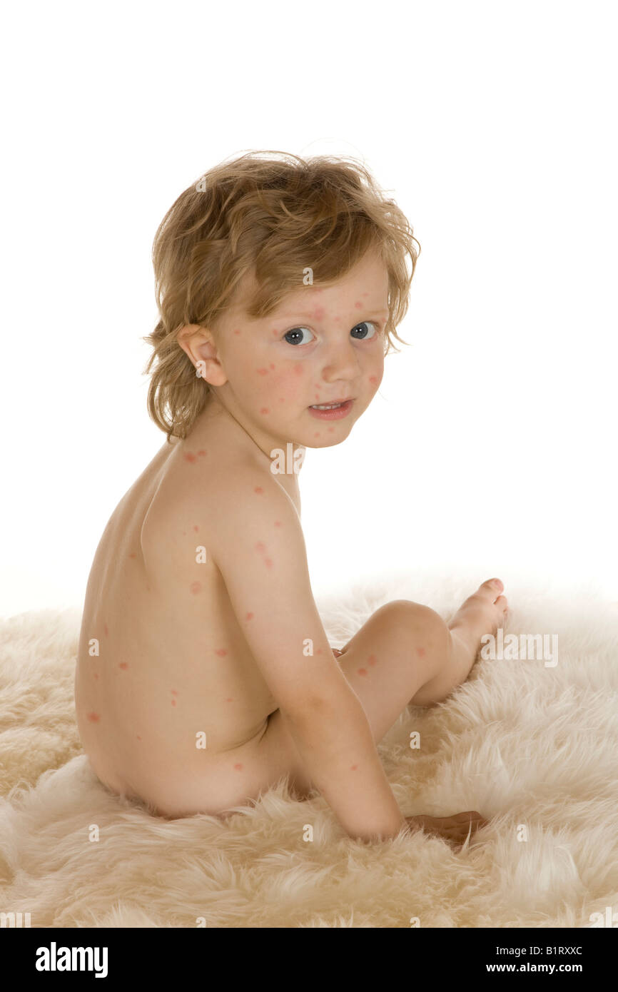 Il Toddler, 2 anni, con la varicella Foto Stock