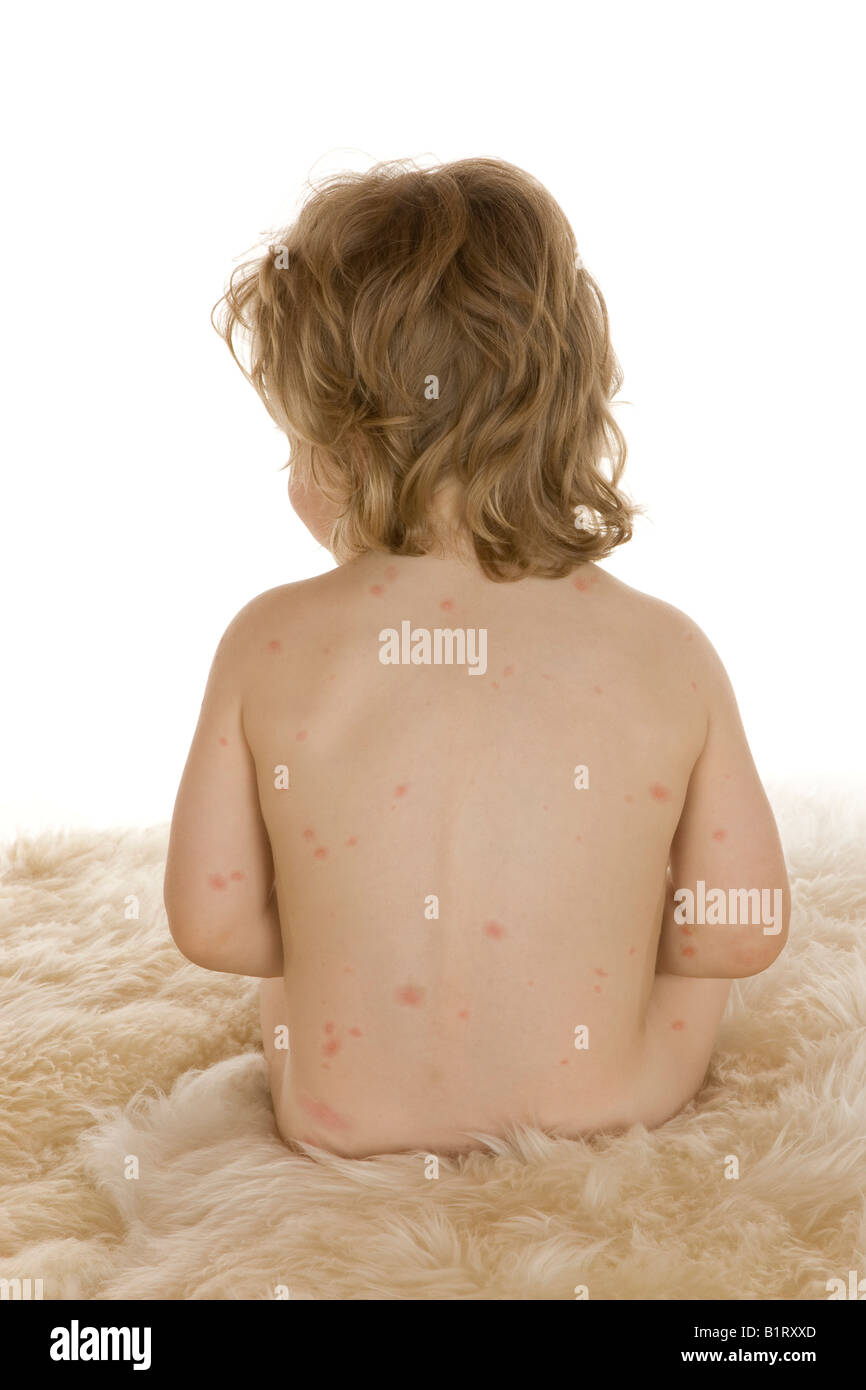 Il Toddler, 2 anni, con la varicella Foto Stock