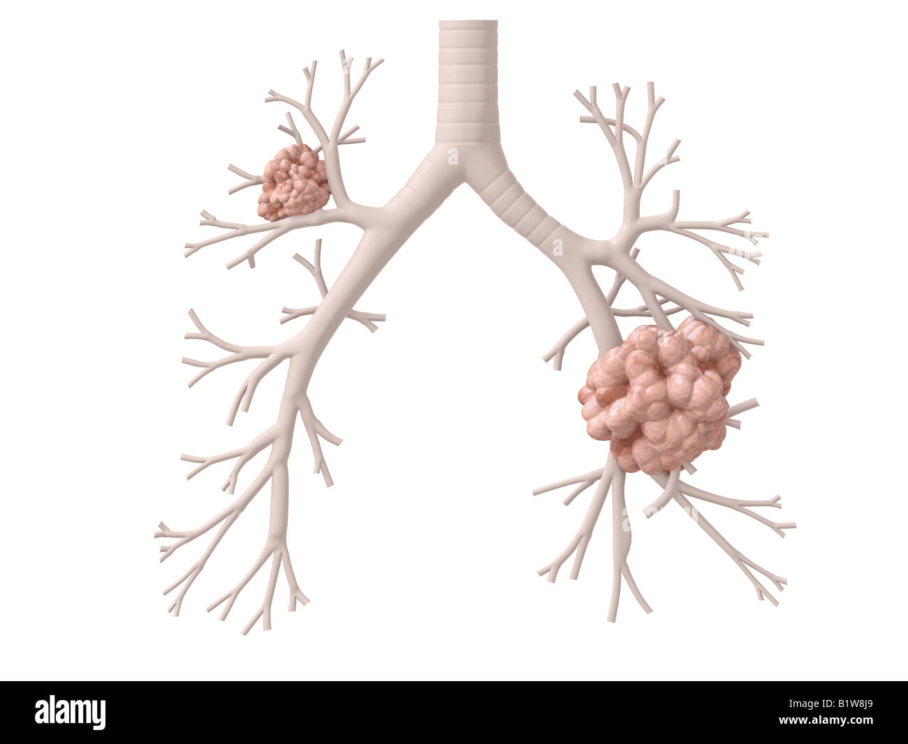 cancro del polmone Foto Stock