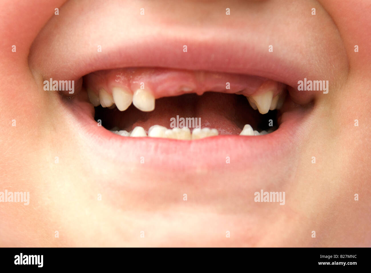 6 anno vecchia ragazza che mostra i suoi denti mancanti. Foto Stock