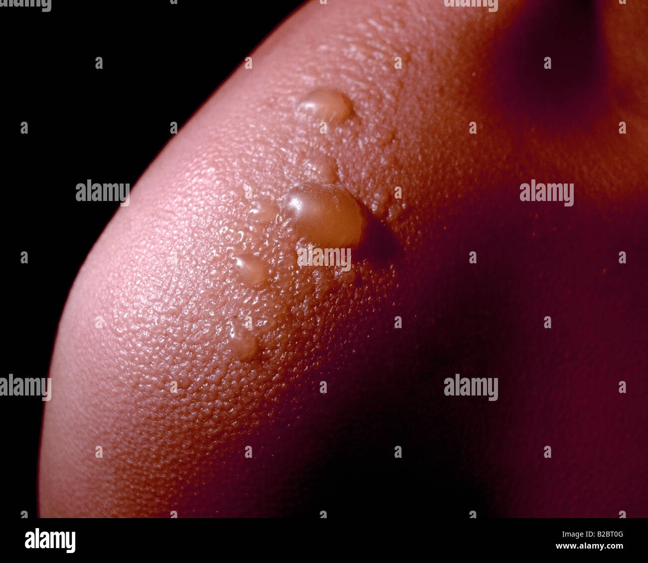 Close up di un gravi scottature blister su una spalla per i bambini Foto Stock