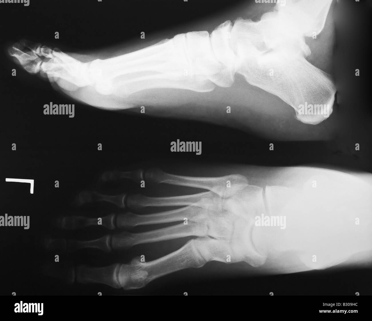 X ray del piede umano Foto Stock