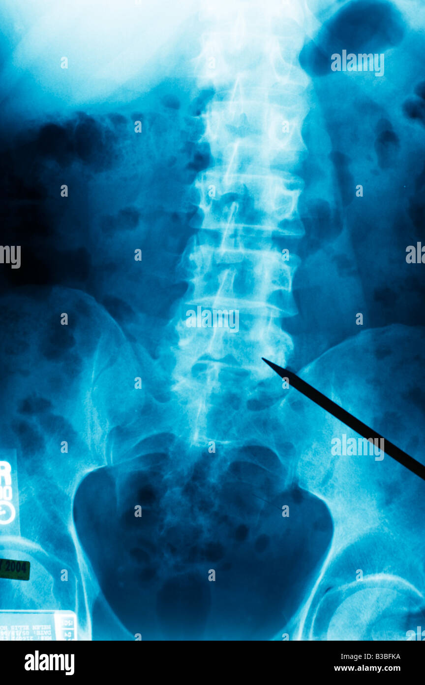 Raggi x maschio umano della colonna vertebrale dispositivo di puntamento Foto Stock