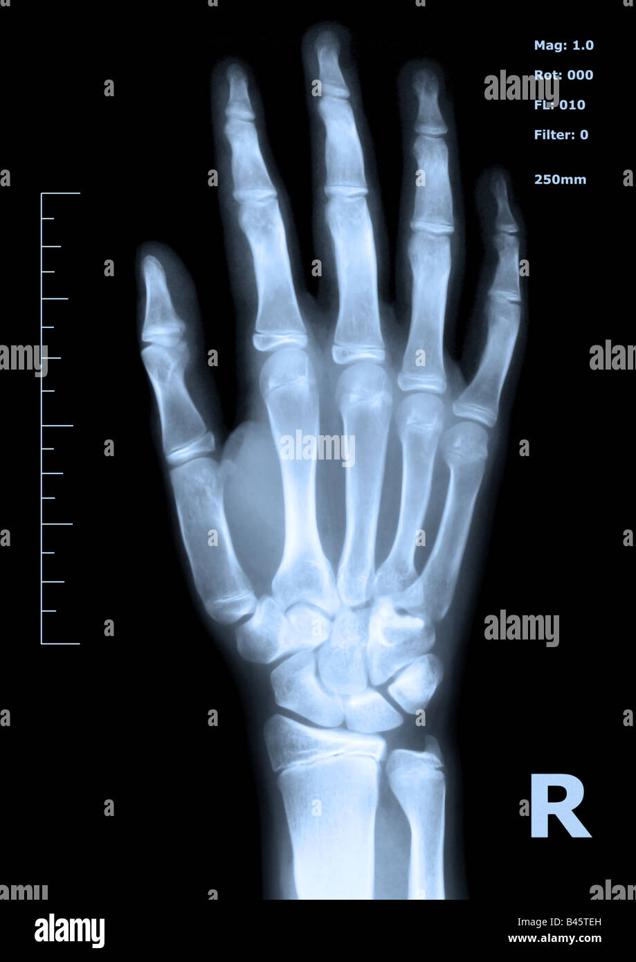 X ray di una mano umana Foto Stock