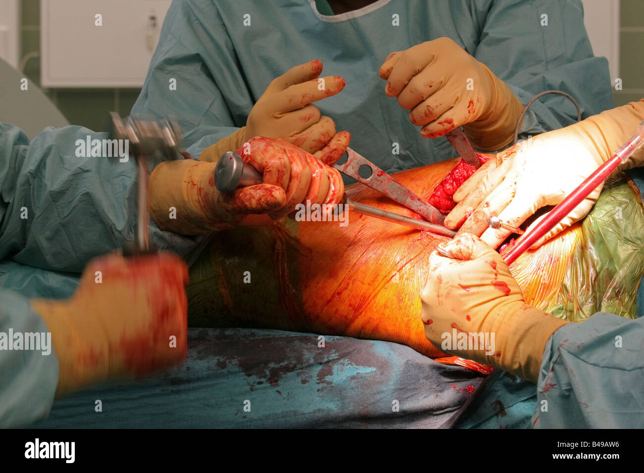 Un acetabolo artificiale viene impiantata durante una chirurgia dell'anca Foto Stock