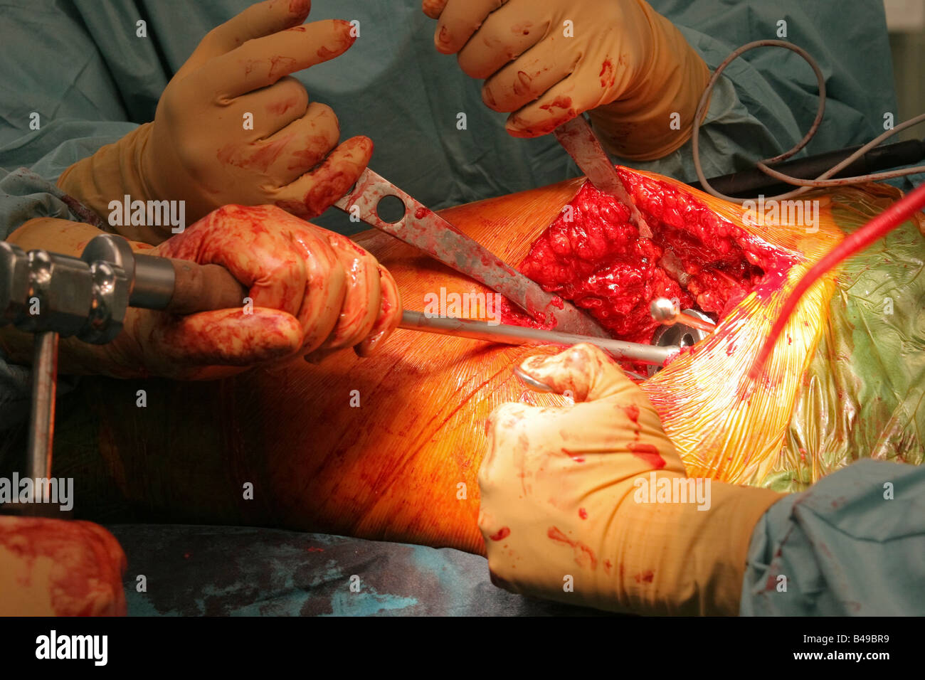 Un acetabolo artificiale viene impiantata durante una chirurgia dell'anca Foto Stock