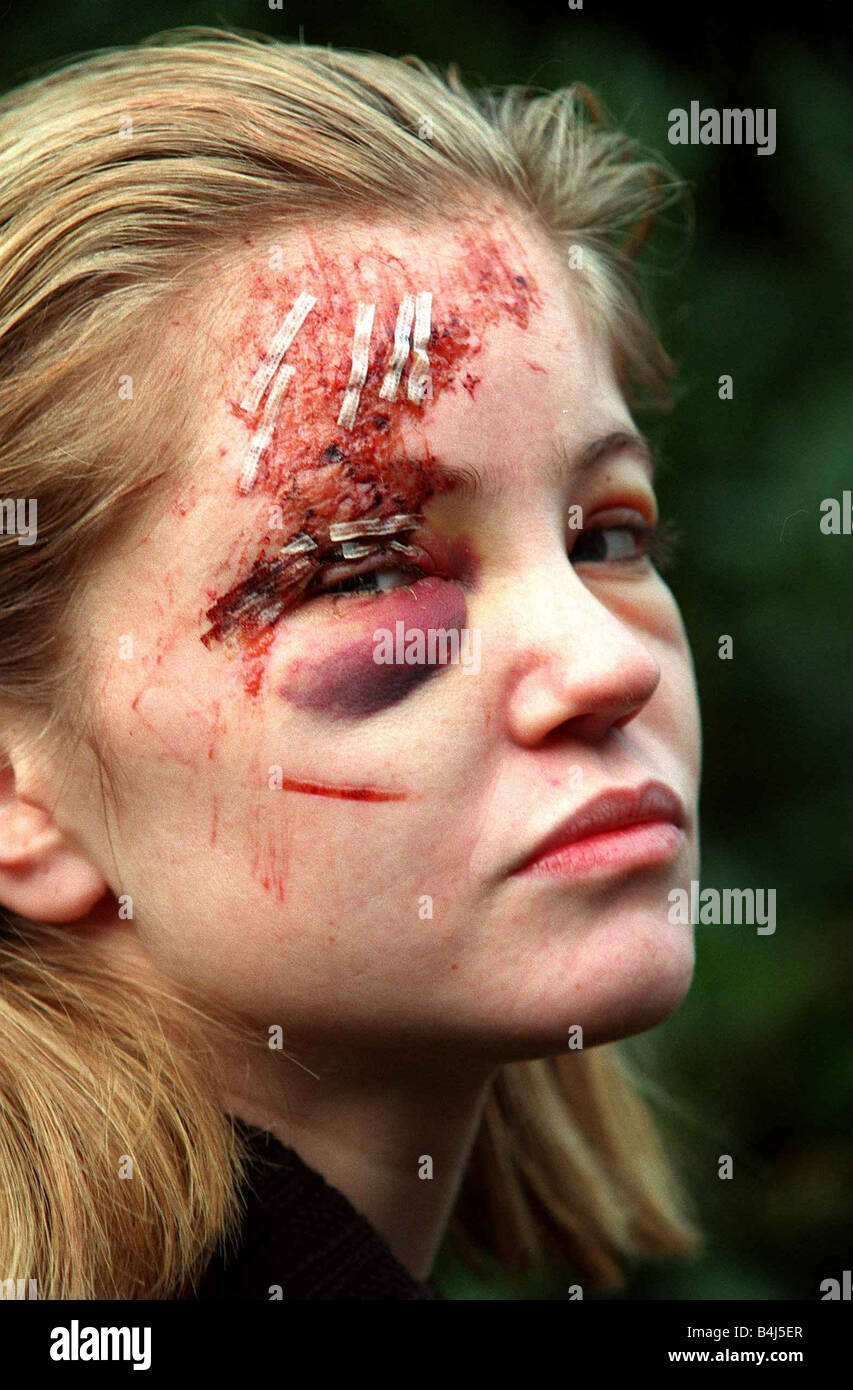 Danniella Westbrook attrice Febbraio 1998 con faccia di taglio occhio nero dopo incidente auto pregiudizio Foto Stock