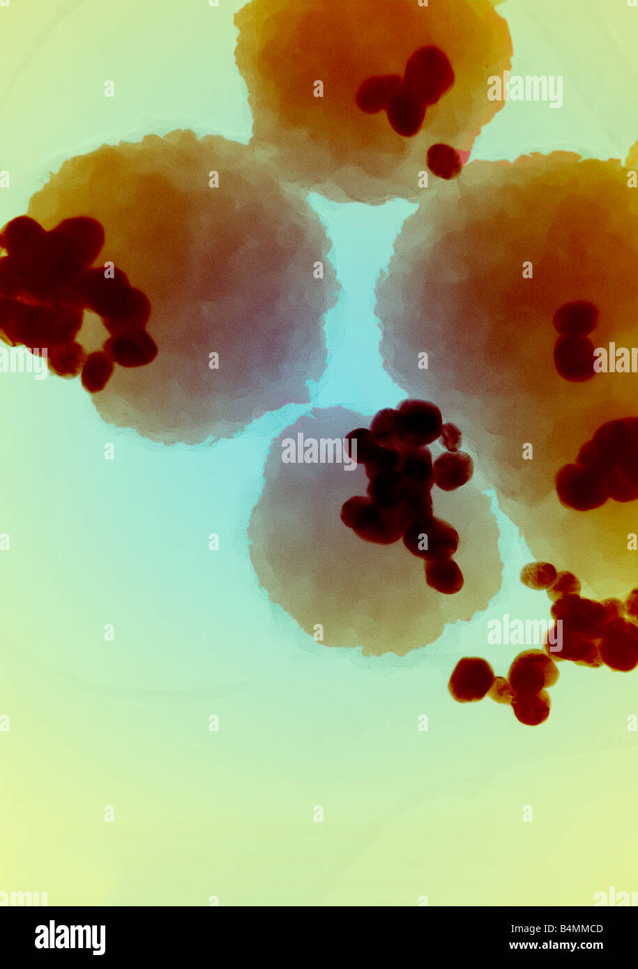 Immagine a falsi colori del cancro cellule attaccate alle cellule umane normali prima del trattamento. Applicazioni mediche di Nanotecnology Foto Stock