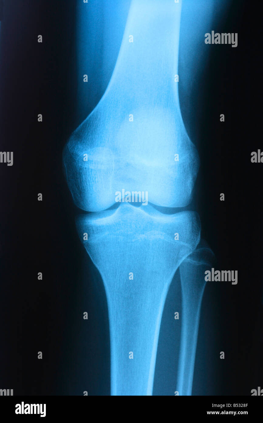 X ray di 15 anni ragazza ginocchio Foto Stock