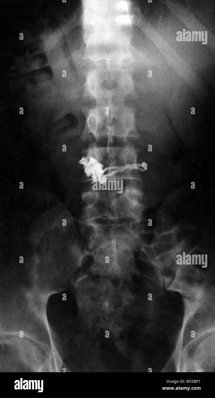 Medical - Raggi X: questa è la foto che condannati Glasgow taccheggiatore James Rodgers. Esso mostra il motivo per il quale il giudice non avrebbe swallow Rodgers' Story -- perché Rodgers aveva chiaramente inghiottito le prove. Store detective in una Glasgow farmacia aveva visto Rodgers prendere una croce su una collana e una bottiglia di shampoo. quando hanno arrestato che lui ha detto, egli intende pagare per lo shampoo. Ma lui non ha la mano sopra la croce. Un detective aveva visto in lui qualcosa di deglutizione, benchè e sentito dire da lui stesso, "ora si vede, ora non lo è più. 'So polizia ha preso Rodgers a un ospedale e lo fece esaminare ai raggi X Foto Stock