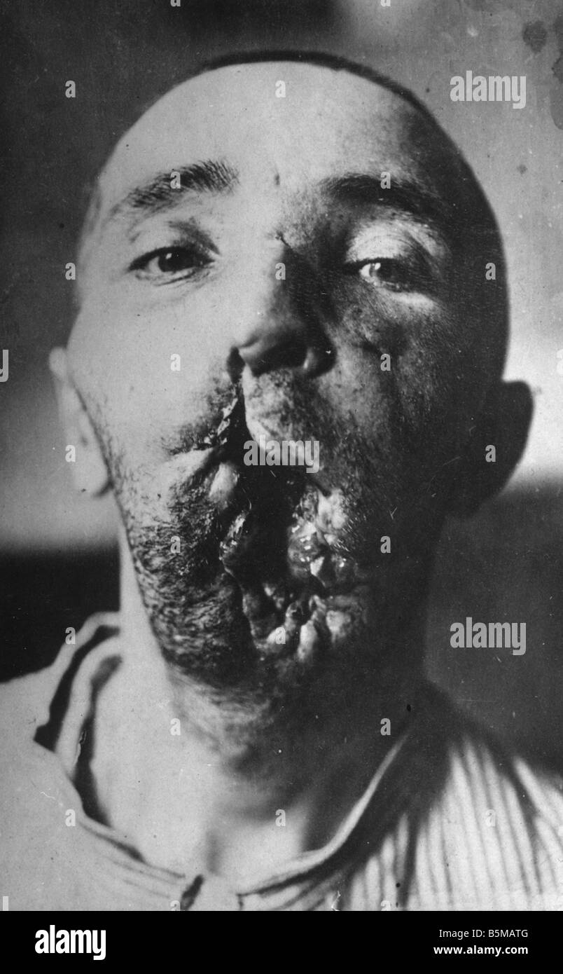 2 M60 L1 1916 1 Soldato con lesioni facciali 1916 militari servizio medico soldato con gravi lesioni facciali foto c 1916 da Foto Stock
