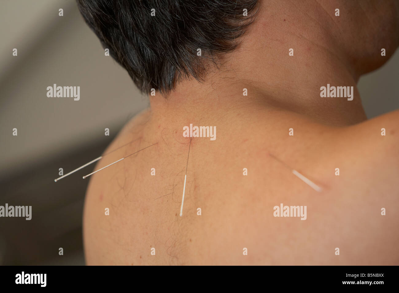 Aghi di agopuntura sull'orecchio e il collo di un uomo adulto degli anni cinquanta Foto Stock