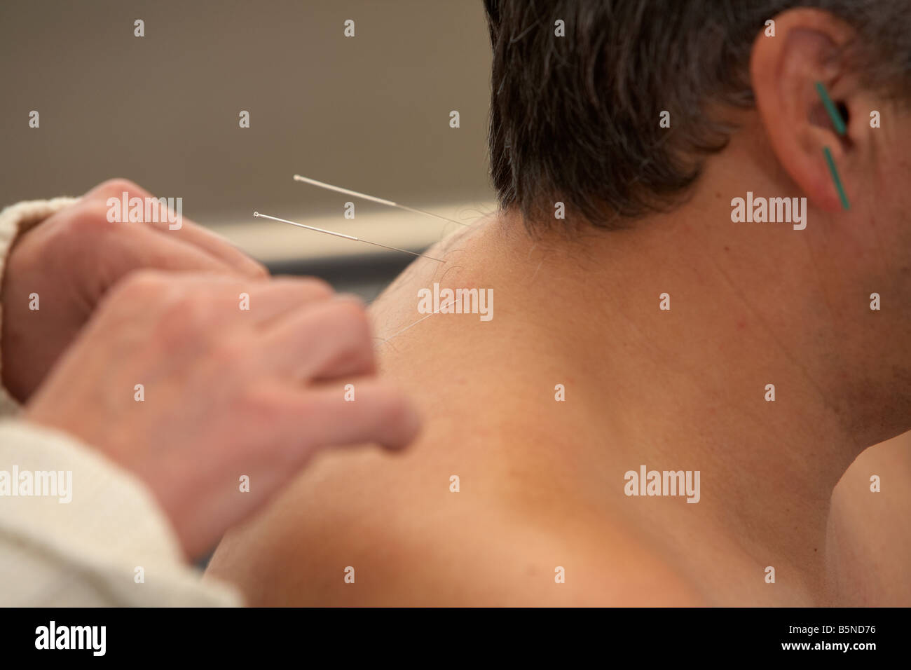 Femmina applicando agopuntore aghi di agopuntura sull'orecchio e il collo di un uomo adulto degli anni cinquanta Foto Stock