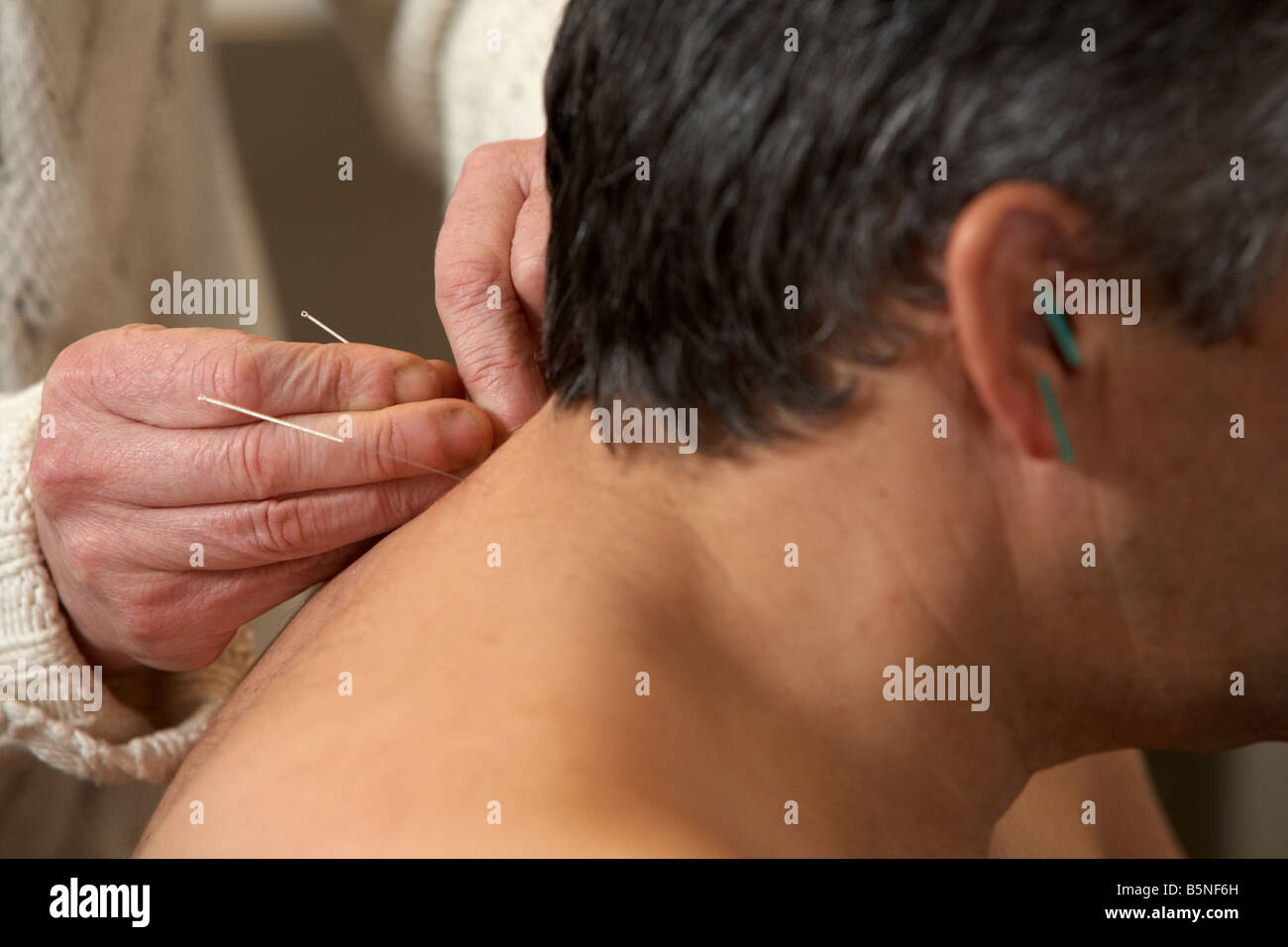 Femmina applicando agopuntore aghi di agopuntura sull'orecchio e il collo di un uomo adulto degli anni cinquanta Foto Stock