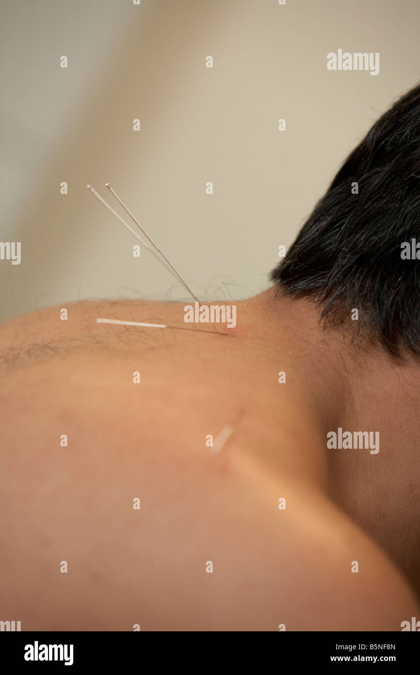 Aghi di agopuntura sull'orecchio e il collo di un uomo adulto degli anni cinquanta Foto Stock