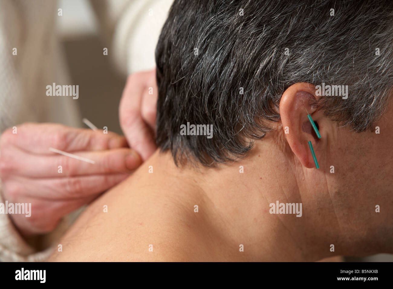 Femmina applicando agopuntore aghi di agopuntura sull'orecchio e il collo di un uomo adulto degli anni cinquanta Foto Stock