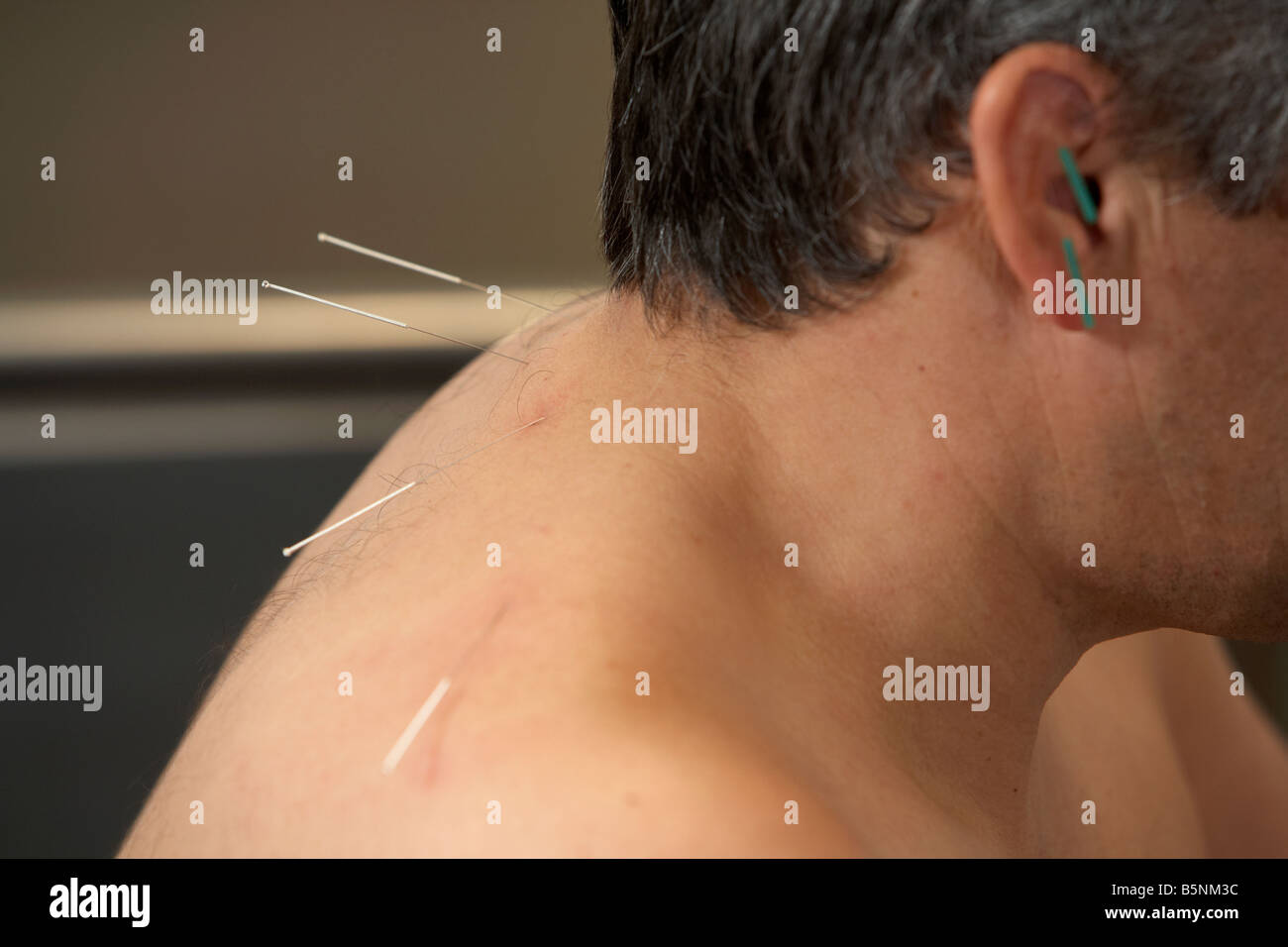 Aghi di agopuntura sull'orecchio e il collo di un uomo adulto degli anni cinquanta Foto Stock