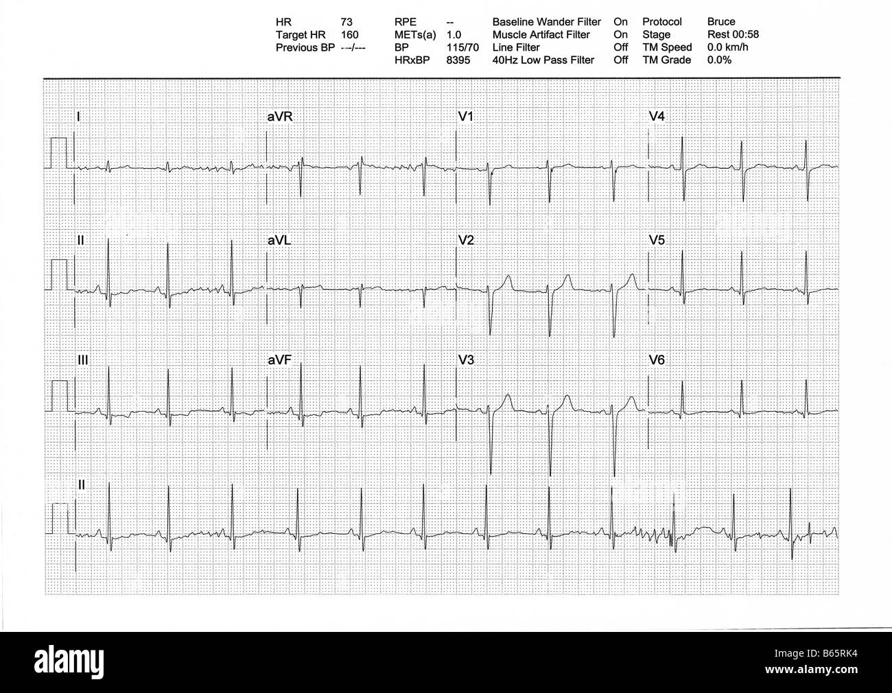 Risultato da un tapis roulant Stress Test. Regolare heartbeat bassa (73bpm) sulla fase di riposo (maschio, 34y). Per saperne di più sulla parte superiore dell'immagine. Foto Stock