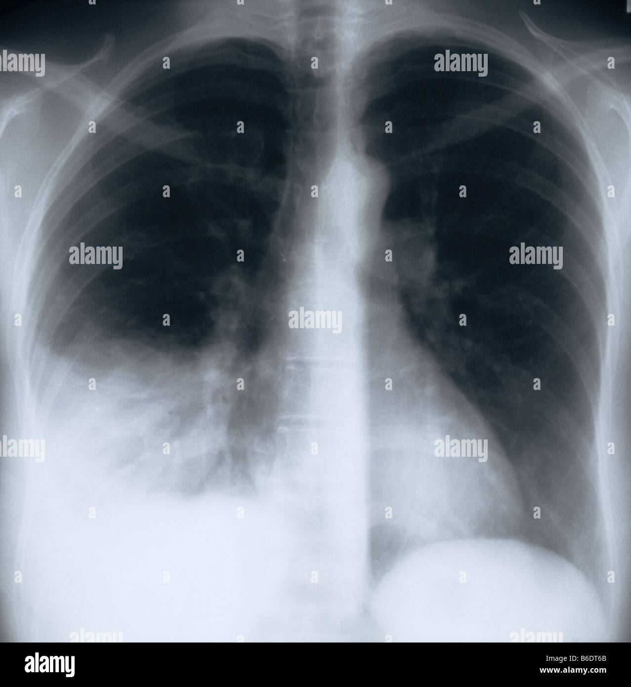 La polmonite. Raggi X del torace di un paziente con polmonite batterica nel lobo inferiore del polmone destro. Foto Stock