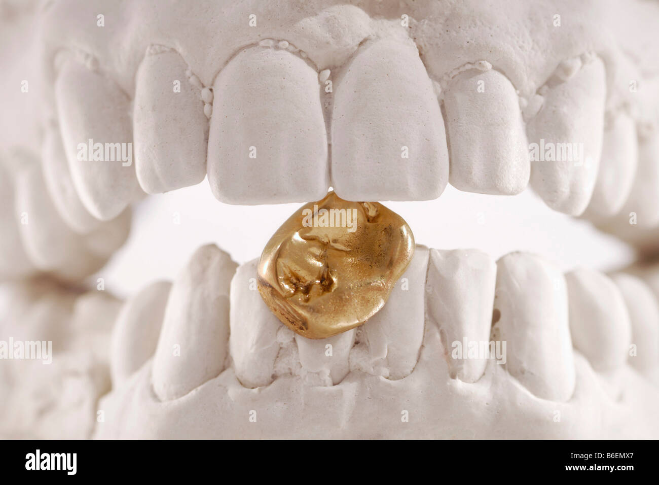 Calco in gesso di un dente con una golden la corona dentale, oro dentale Foto Stock