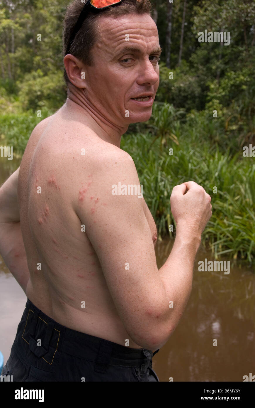 Uomo con punture di zanzara sulla sua schiena vicino a un fiume nel Borneo Foto Stock