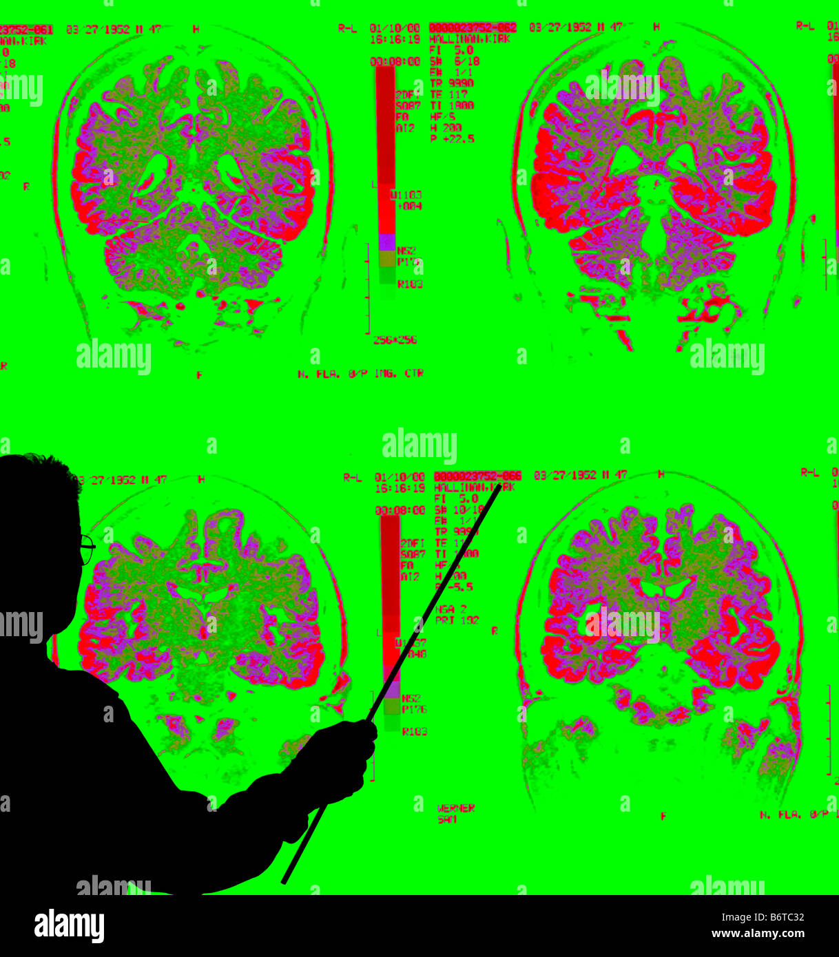 Istruttore con MRI colorati di corteccia cerebrale di cervelletto di cervello umano Foto Stock