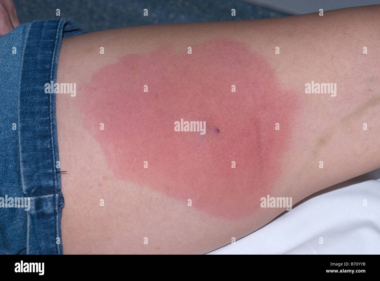 Staphylococcus aureus resistente alla meticillina MRSA infezione della pelle  sulla coscia Foto stock - Alamy