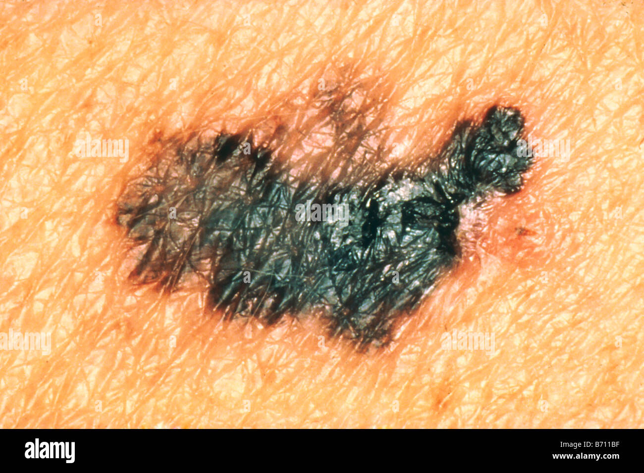 Il melanoma maligno, potenzialmente letale di cancro della pelle Foto Stock