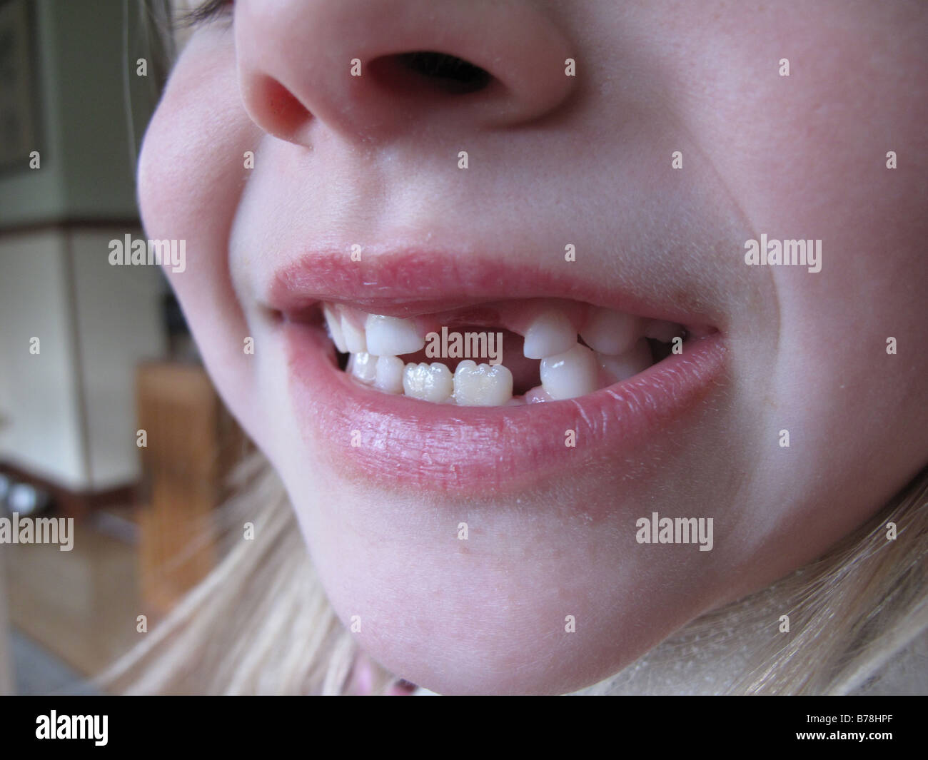 Un bambino di sei anni ragazza sorride, che mostra gli spazi dove il suo latte o denti di bambino sono caduti, in una casa di Rayleigh, Essex Foto Stock