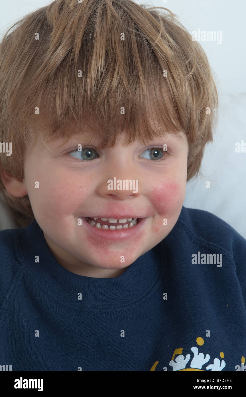 Bambino malato con una faccia molto dolorosa a causa di un prolungato raffreddore e tosse e naso che cola, ma felice e sorridente Foto Stock