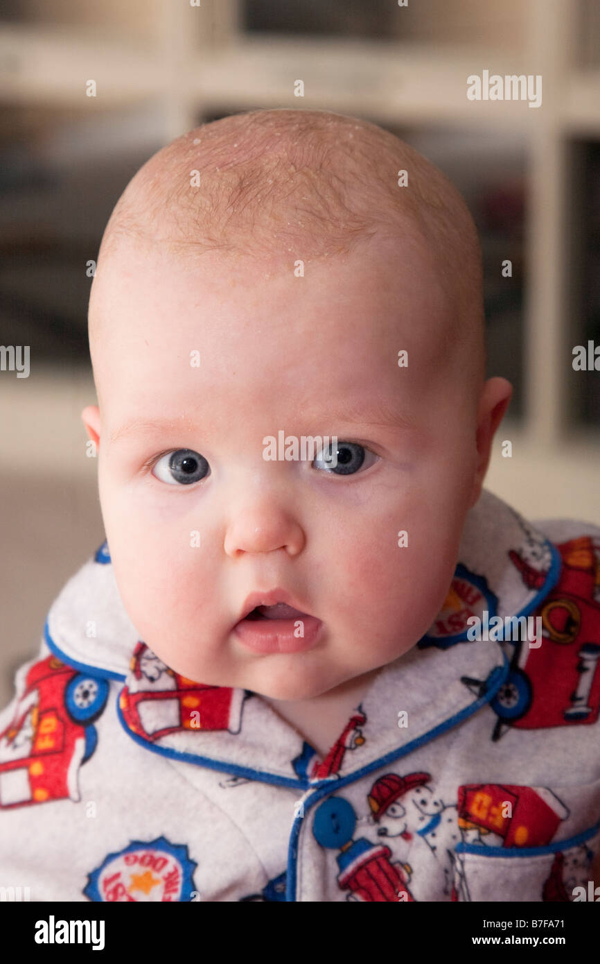 Baby, età 5 monthss, con un lieve caso di base cap, una condizione del cuoio capelluto che colpisce i bambini. Foto Stock