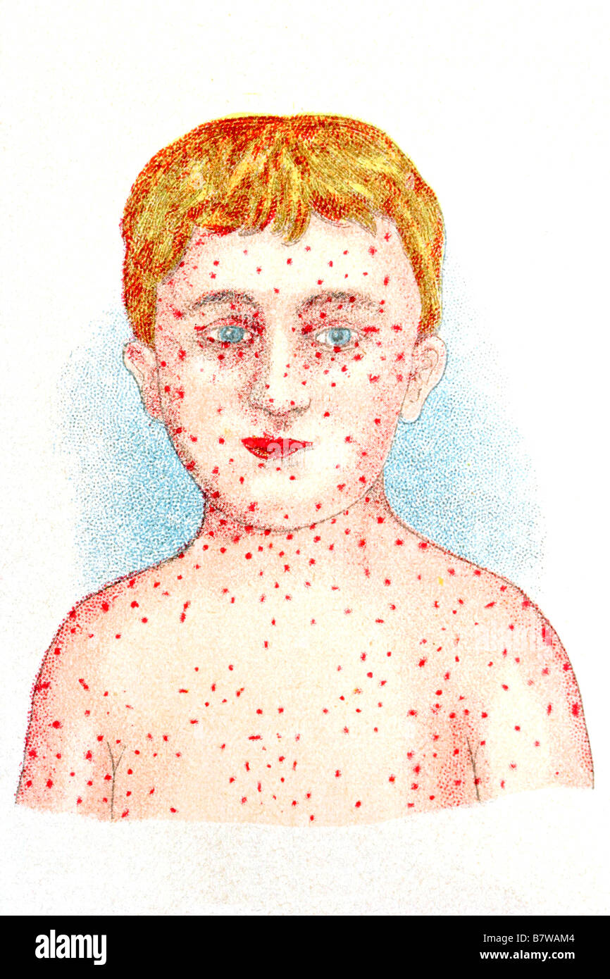 Illustrazione di antiquariato in un libro di medicina. 1920. Ragazzo con il morbillo Foto Stock