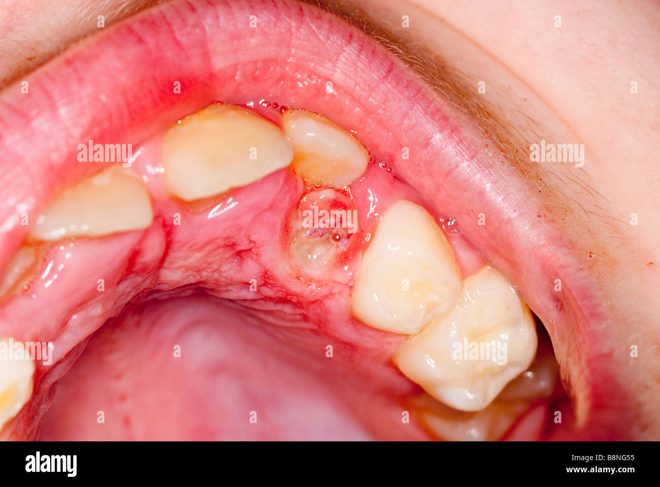 Una chiusura di un bambino a bocca aperta con il vuoto lasciato dopo il suo bambino dente di latte è caduto fuori Foto Stock