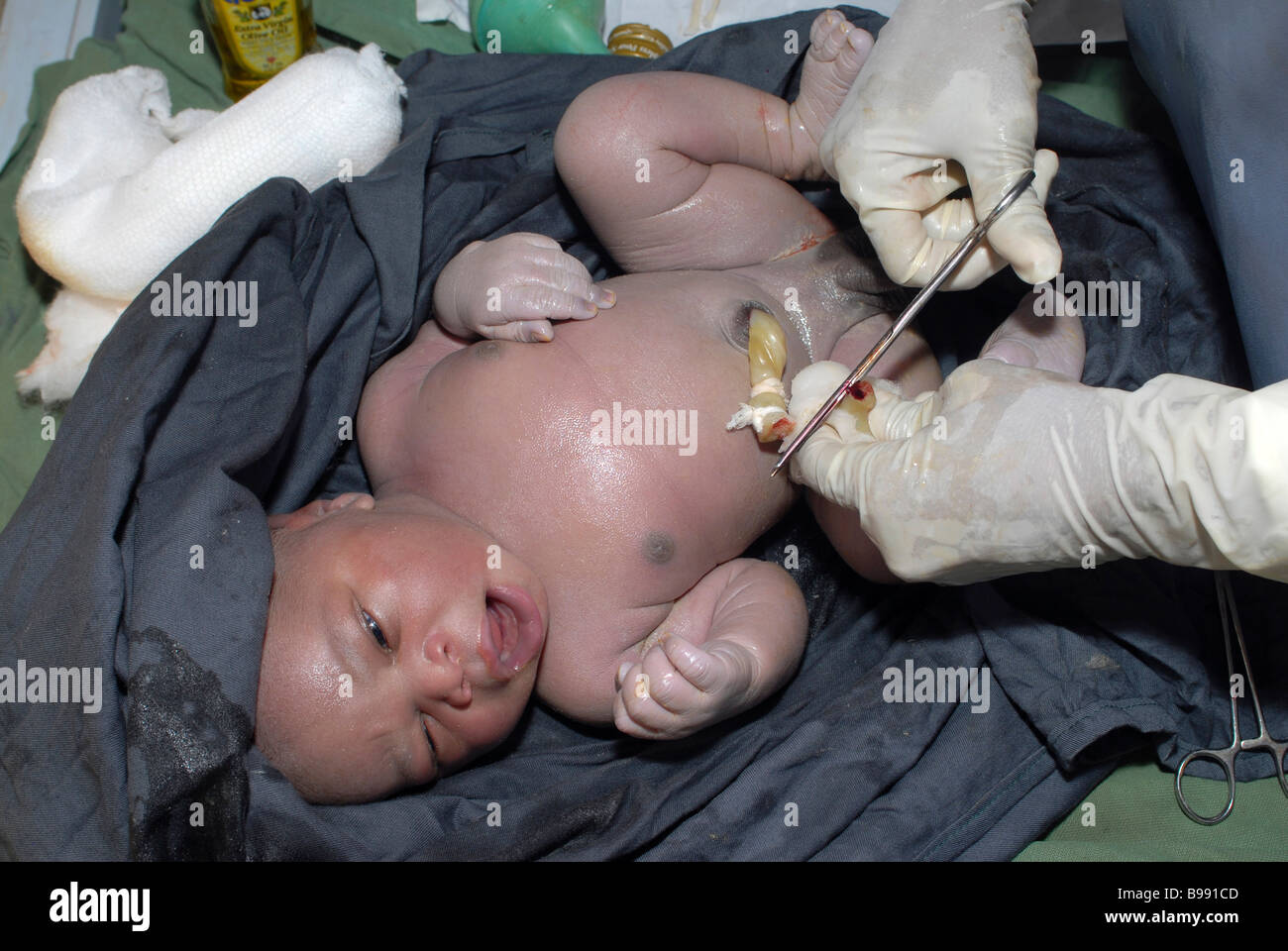 Nigeriano neonato bambino africano erogata mediante taglio cesareo in un ospedale della comunità Foto Stock