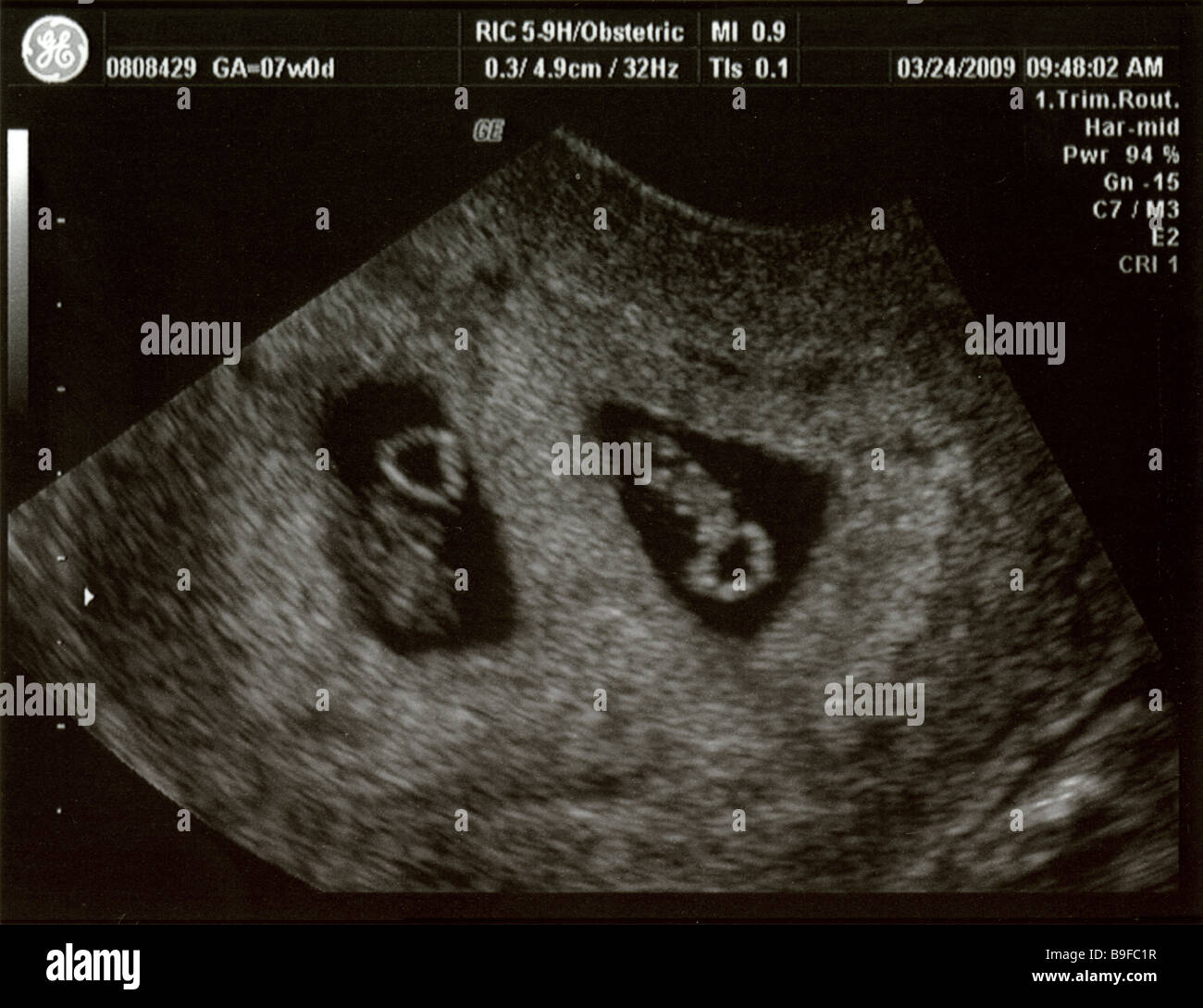 Ecografia che mostra lo sviluppo fetale di gemelli fraterni a 7 settimane, concepiti tramite fecondazione in vitro. Foto Stock