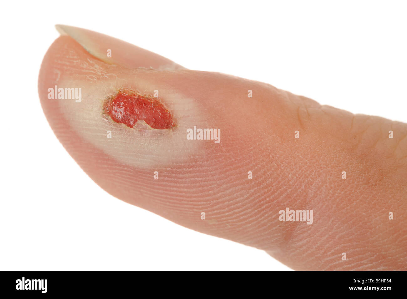 Di secondo grado dito bruciato con un trafitto burn blister sull'epidermide e distrutto lo strato papillare (stratum papillare) Foto Stock