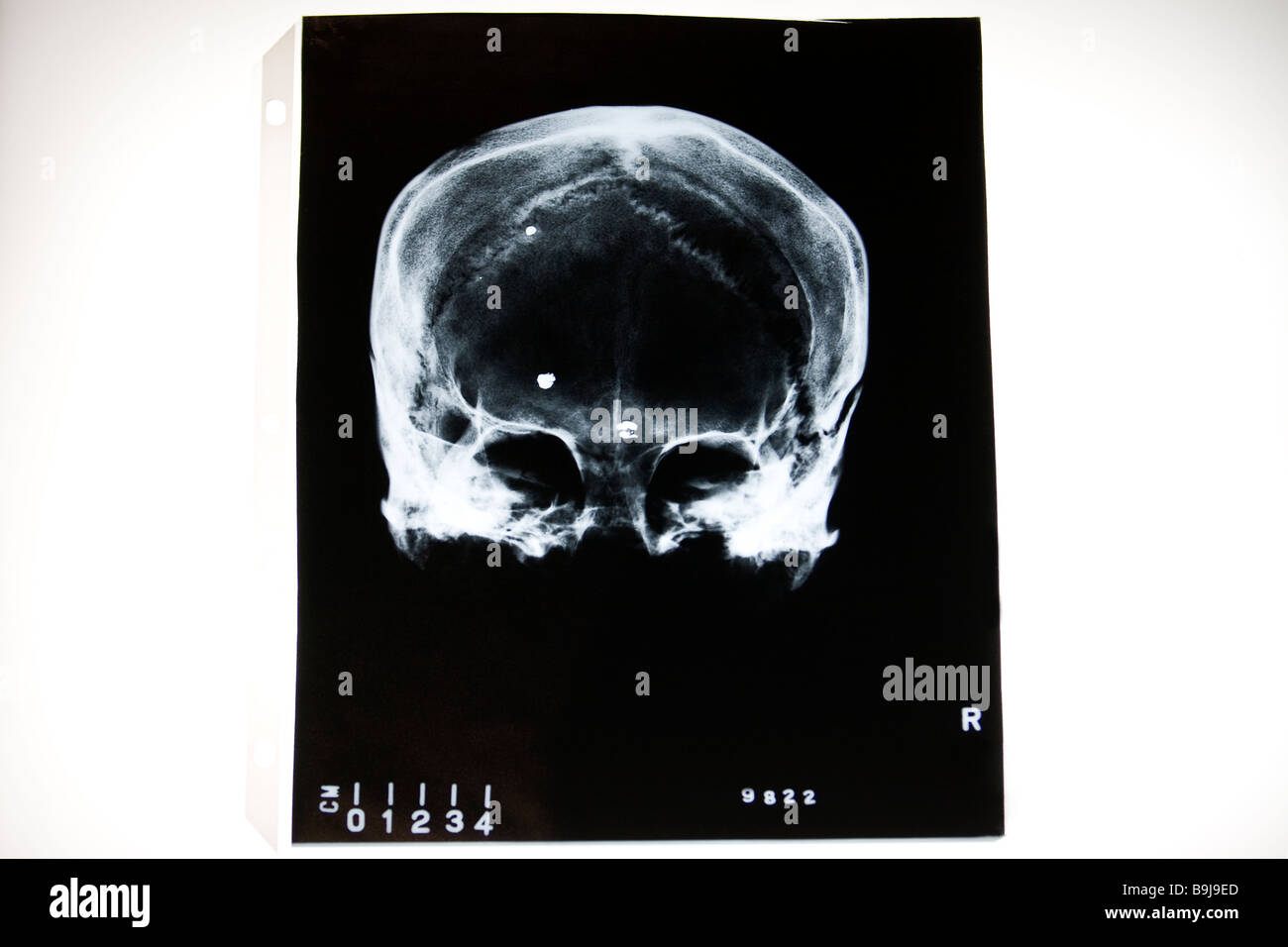 Raggi X del cranio umano con frammenti di stranieri Foto Stock