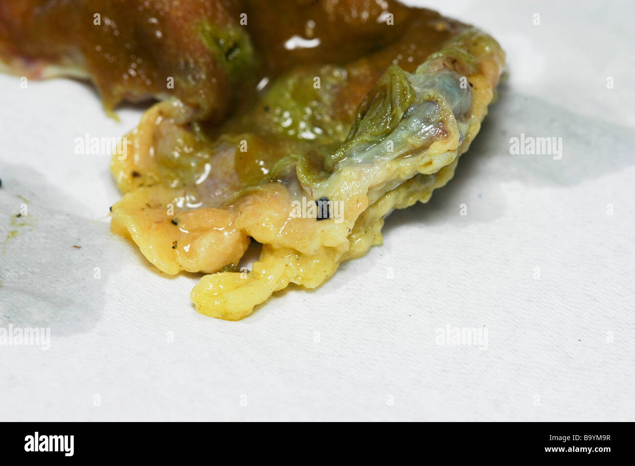 Human Cistifellea immediatamente dopo la rimozione Foto Stock