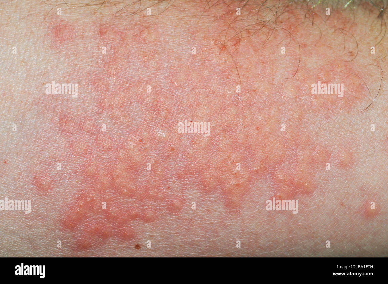 Close up di rash sul braccio dal portoghese di uomo o' guerra (Physalia physalis), noto anche come la bolla blu, blu bottiglia, uomo di guerra Foto Stock